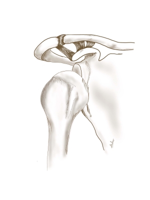 Εξάρθρημα του ώμου