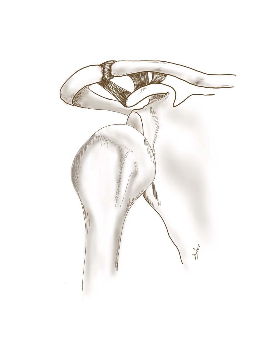 Εξάρθρημα του ώμου