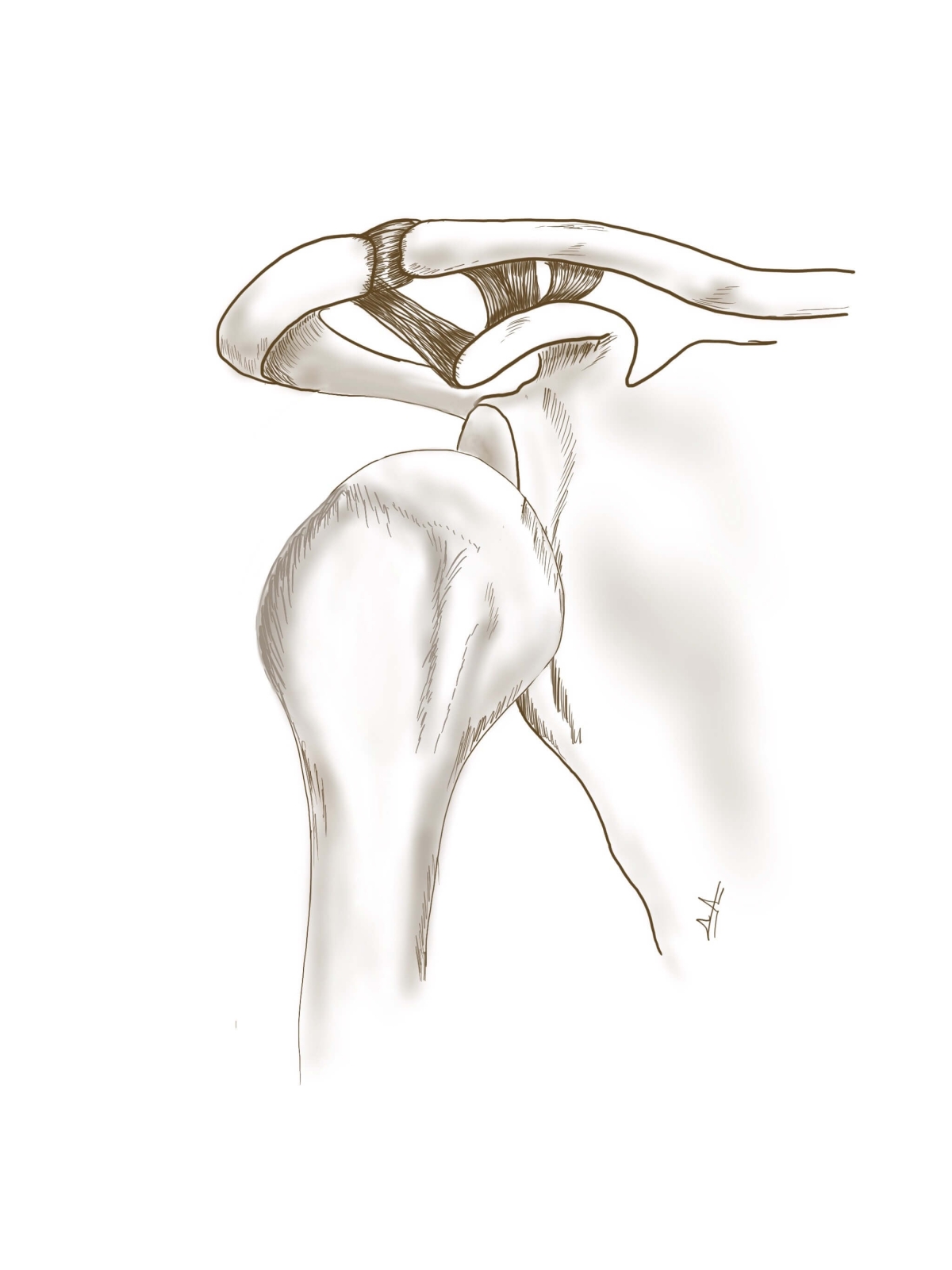 Εξάρθρημα του ώμου