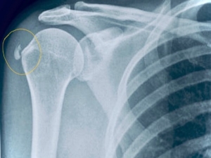 Ασβεστοποιός Τενοντίτιδα του Ώμου