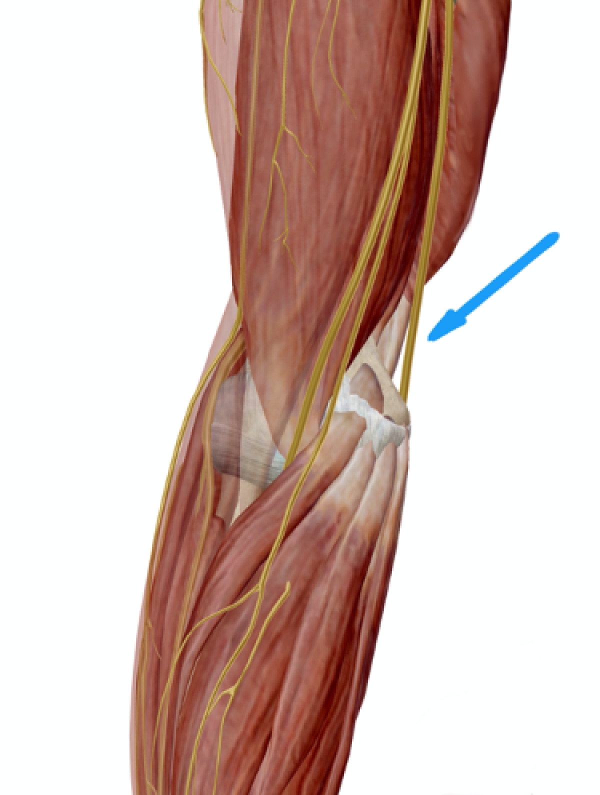 Ωλένια Νευρίτιδα