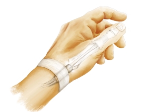 Στενωτική τενοντοελυτρίτιδα 1ου ραχιαίου διαμερίσματος