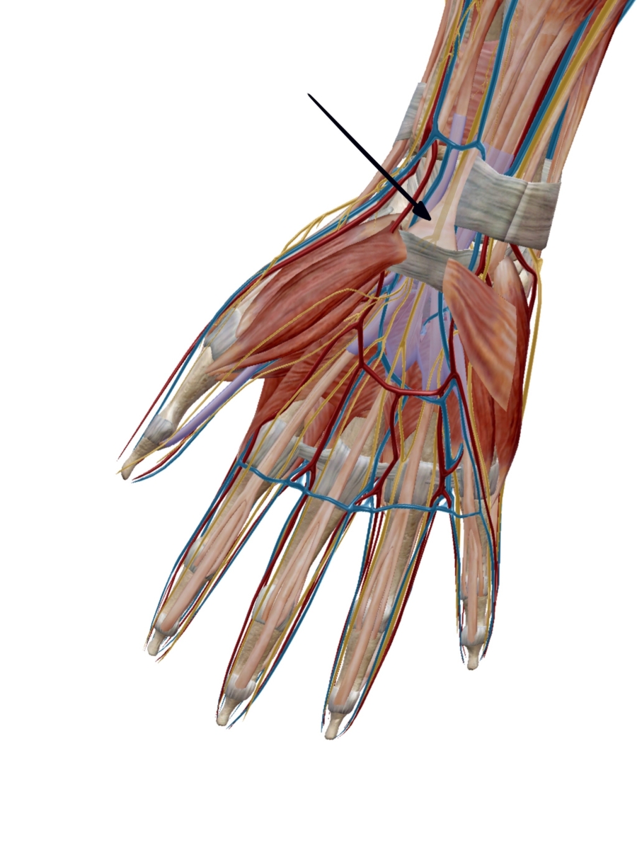 Σύνδρομο Καρπιαίου Σωλήνα