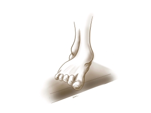 Διάστρεμμα ποδοκνημικής άρθρωσης